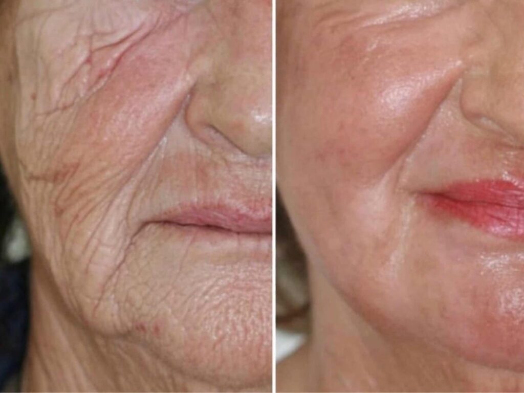 peeling-o-que-e-tipos-de-peeling-cuidados-e-antes-e-depois-6.jpg